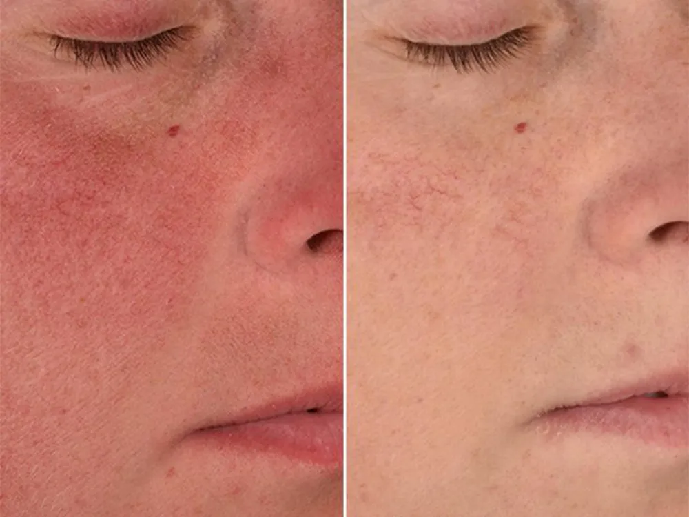 کرم ترمیم کننده