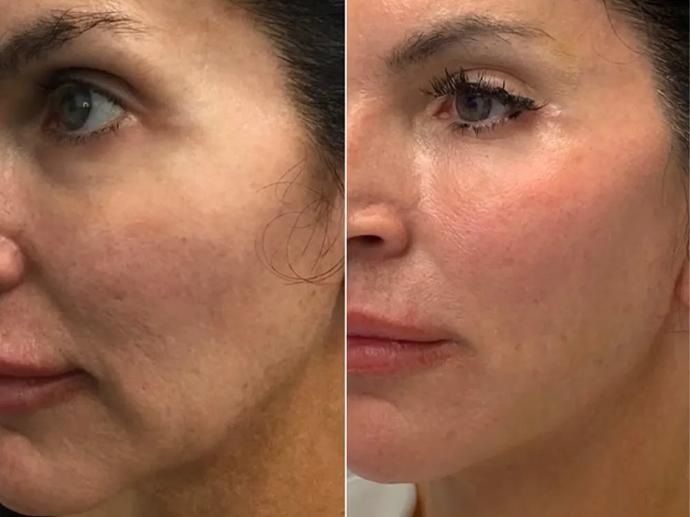 کرم لیفت کننده